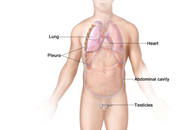 Factors Looked at When Determining the Prognosis of Mesothelioma